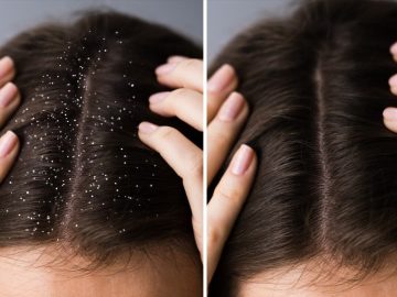 remedii anti matreata